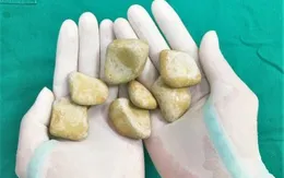 Cứu bệnh nhân bị súng bắn, bất ngờ phát hiện 7 viên sỏi lớn trong bàng quang