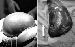 Cắt khối u lách kích thước "khủng" dọa vỡ cho bệnh nhân 70 tuổi