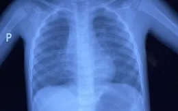 Bé trai 30 tháng tuổi nguy kịch do uống nhầm nước tẩy mực in