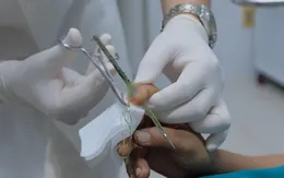 Nhập viện cấp cứu vì kim thêu đâm xuyên ngón tay