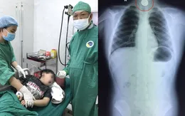 Bắt chước ảo thuật gia, bé trai 8 tuổi suýt chết vì đồng xu mắc ở cổ