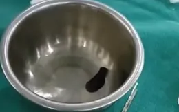 Gắp con vắt dài 5cm ra khỏi hốc mũi bệnh nhi 7 tuổi