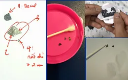 Hi hữu: Bé gái 15 tháng nuốt 7 mảnh dao lam vào bụng