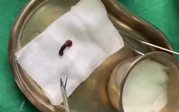 Bị chảy máu mũi khi đi chăm người nhà, bác sĩ khám phát hiện đỉa sống ký sinh