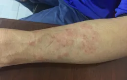 Cảnh báo tình trạng nhiễm sán chó, mèo