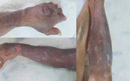 Trị liệu oxy cao áp hiệu quả cho bệnh nhân bị bỏng xăng nặng