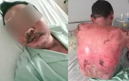 Cảnh báo nguy cơ tử vong do dị ứng thuốc gây ra hội chứng Lyell
