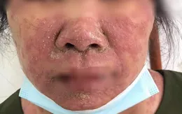 Tự điều trị dị ứng tại nhà, bệnh nhân bị tổn thương da nặng
