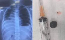 Cảnh báo hóc hạt trái cây ở trẻ
