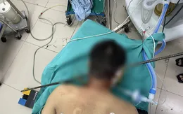 Tai nạn lao động, nam thanh niên bị thanh sắt dài 1m  xuyên thấu từ cổ qua não
