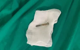 Gắp đinh vít dài 5cm trong tá tràng bệnh nhi 7 tuổi