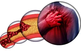 Nhật Bản ứng dụng công nghệ đột phá mới trong đẩy lùi bệnh máu nhiễm mỡ