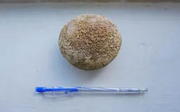 Phẫu thuật lấy sỏi kích thước 9cm trong bàng quang bệnh nhân