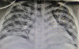 Thêm 1 trẻ béo phì mắc COVID-19 nguy kịch được cứu sống