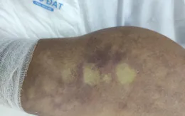 Cảnh báo một trường hợp nhiễm liên cầu lợn tiên lượng xấu