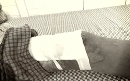 Nhiễm trùng vết bỏng nặng do tự đắp thuốc nam điều trị tại nhà