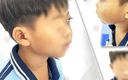 Bé 9 tuổi có nguy cơ bị mù do khối u vùng hàm mặt