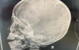 Bệnh viện Xanh Pôn bác tin bé 3 tuổi có đinh găm ở đầu sắp được phẫu thuật