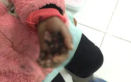 Viêm loét bàn tay nặng do tự ý sử dụng thuốc điều trị viêm da dị ứng