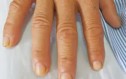 Bệnh nhân bị rối loạn đông máu do hóa chất thúc ép trái cây chín nhanh