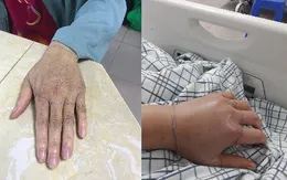 Cứu sống kịp thời người bệnh bị rắn lục cắn