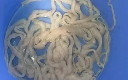 Quảng Nam: Sán xơ mít dài 10m được lấy ra từ cơ thể 1 bệnh nhân nam