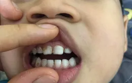 Phòng ngừa sâu răng ở trẻ em