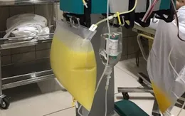 Người phụ nữ có huyết tương trắng như sữa do viêm tụy cấp nặng