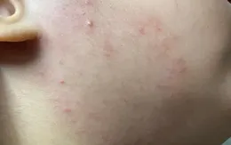 Cách hạn chế viêm da mùa lạnh