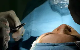 Tiêu chuẩn của một ca cắt mí mắt đẹp