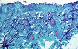 Giải mã virus: Đậu mùa khỉ và những câu hỏi nóng nhất