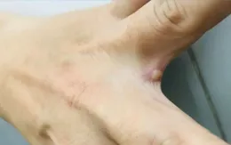 Đắk Lắk triển khai phương án phòng, chống bệnh đậu mùa khỉ