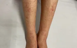 Cẩn trọng với sốt xuất huyết Dengue