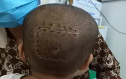 Phẫu thuật thành công khối u màng não cho bệnh nhi nhỏ tuổi