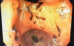Bé 10 tuổi vào viện vì hoa mắt chóng mặt, bác sĩ phát hiện nhiều ổ loét vùng tá tràng gây xuất huyết tiêu hóa