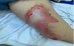 Phỏng cồn ở trẻ em: Những điều cần lưu ý