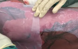 Cô gái trẻ nguy kịch do hội chứng Lyell nặng, diện tích trợt thượng bì 95% diện tích cơ thể