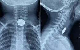 Bé 3 tuổi bị bỏng thực quản do nuốt pin cúc áo