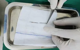 Vào viện khám vì gãy tay, bác sĩ bất ngờ phát hiện kim khâu trong phổi bé trai 4 tuổi