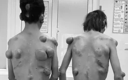 Phẫu thuật cho 2 bệnh nhân sinh đôi mắc bệnh hiếm gặp với hàng trăm khối u