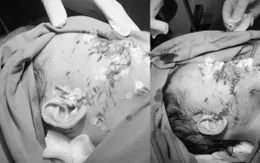 Bé 28 tháng tuổi bị chó cắn gây tổn thương nghiêm trọng vùng mặt