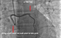 Cấp cứu bệnh nhân nhồi máu cơ tim cấp có bất thường giải phẫu động mạch vành