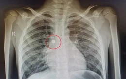 Bệnh nhi 6 tuổi nhập viện do nuốt phải pin cúc áo