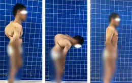 Phẫu thuật lấy lại hình dáng cho người đàn ông bị gù vẹo cột sống