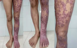 Chromoblastomycois - bệnh nhiệt đới bị lãng quên