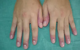 Nên làm gì khi bị cước tay, chân vào mùa đông?