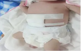 Cứu sống bé sơ sinh chào đời có ruột nằm ngoài ổ bụng