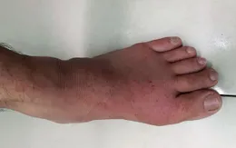 Bệnh gout: Lý do nhiều người phát bệnh hoặc bị nặng lên sau kỳ nghỉ Tết