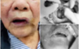 Phẫu thuật điều trị ung thư niêm mạc má cho bệnh nhân cao tuổi