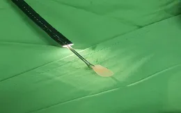 Nội soi lấy đầu bút bi trong phế quản bé 2 tuổi